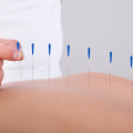 Advantages Of Hiring An Acupuncturist Skilled In Natural Remedies In Okotoks, AB