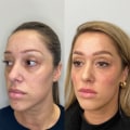 The Professional Difference: Dermal Fillers Vs. Natural Remedies For Anti-aging In Scottsdale, AZ