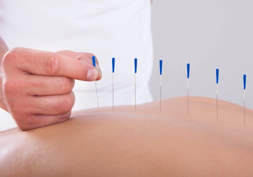 Advantages Of Hiring An Acupuncturist Skilled In Natural Remedies In Okotoks, AB