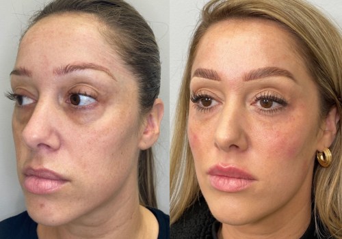 The Professional Difference: Dermal Fillers Vs. Natural Remedies For Anti-aging In Scottsdale, AZ